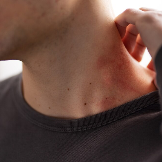 strep-throat