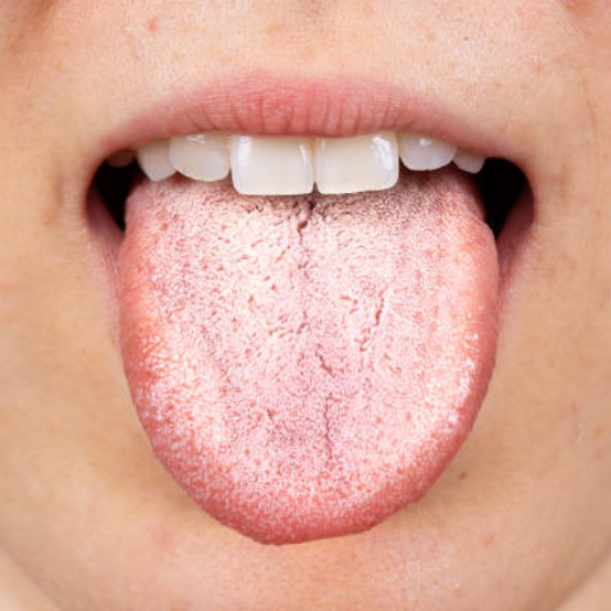 strep-throat